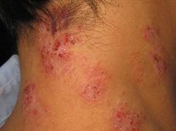 怎么做才能预防脂溢性皮炎严重化