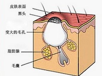 毛囊炎有哪些症状及类型