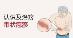 带状疱疹后遗症应该怎么办好 