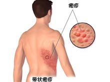 带状疱疹的症状表现