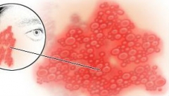 带状疱疹的预防办法当科学运用