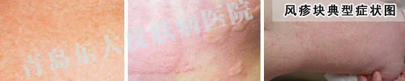 风疹块的症状有哪些 风疹块的症状有哪些