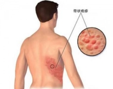 带状疱疹的症状图片