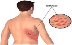 得了带状疱疹饮食上注意什么