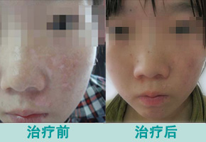 白癜风是什么引起的 白癜风是什么引起的